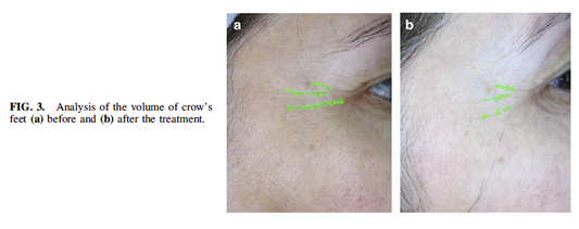 Does Red Light Therapy Reduce Wrinkles by 30%? Yes it does.